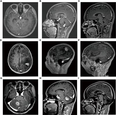 Clinical Impact of the Histopathological Index and Neuroimaging Features Status in Primary Central Nervous System Diffuse Large B-Cell Lymphoma: A Single-Center Retrospective Analysis of 51 Cases